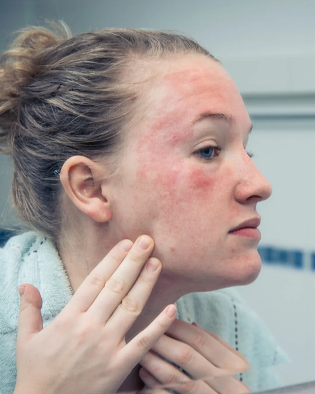 Skin Concern Rosacea 1