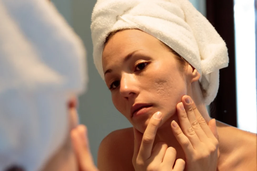 Acne-Treatment-Microneedling-Treatment-For-Acne