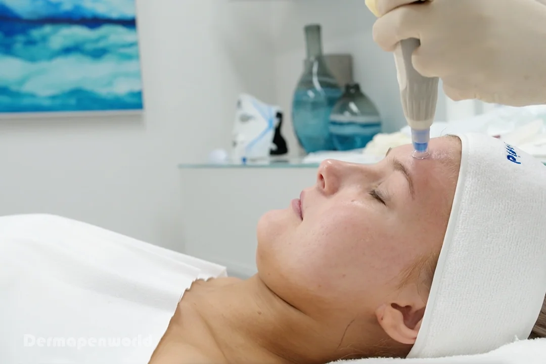 Dermapen Treatment™️ Offers Fast Results