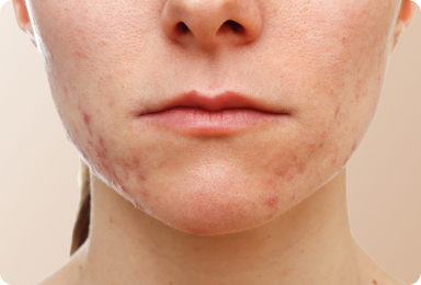 Acne & Erupções Cutâneas Image