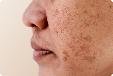 Envelhecimento / Danos causados pelo sol Image