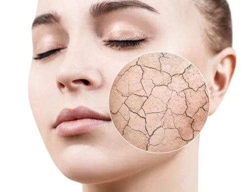 The-Top-3-Side-Effects-Of-At-Home-Microneedling-Gone-Wrong