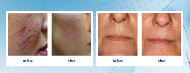 Micro-Needling-Give-You-Better-Looking-Skin-640x247