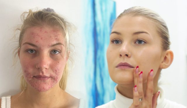 How To Treat Acne-640x368