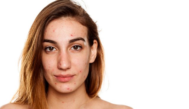 Types Of Acne-640x368