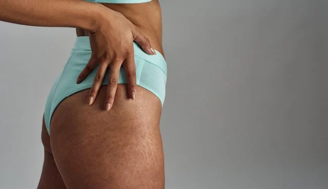 Do-Stretch-Marks-Go-Away-1-640x368