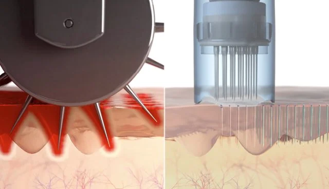 Dermapen Vs Dermaroller-640x368
