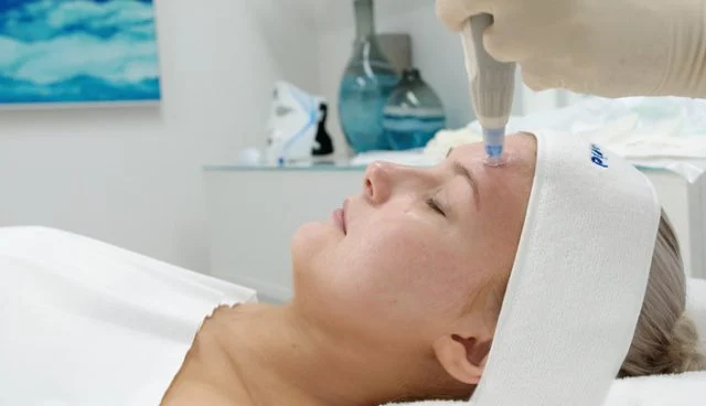 Acne-Scars-Microneedling-640x368