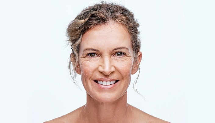 White Spots On Skin From Sun