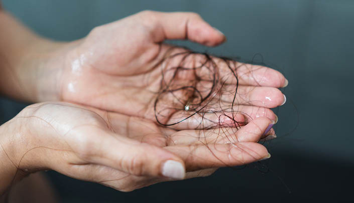 Hair Loss Ruined My Life 1