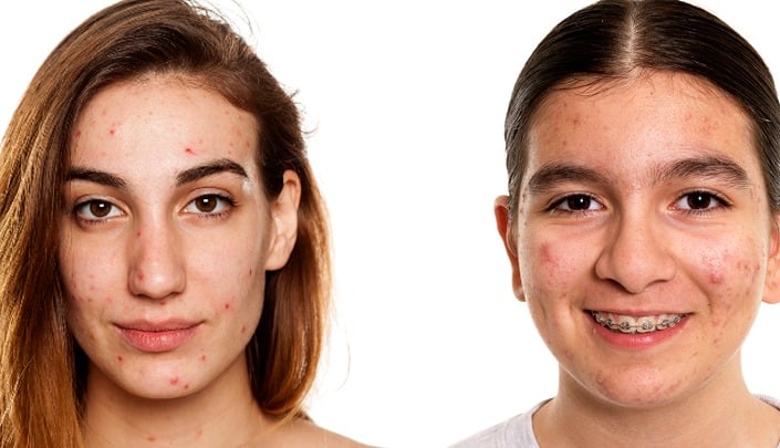 Acne-Awareness Blog-Images