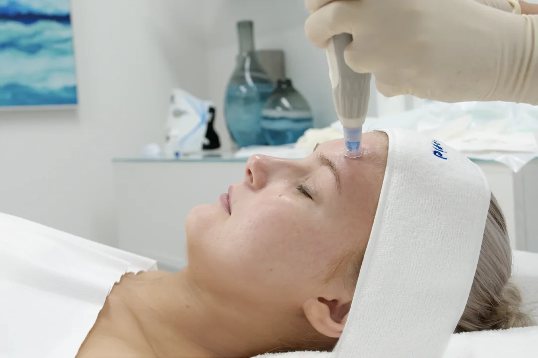 Microneedling In Clinic